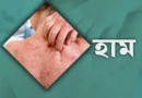 হাম উপসর্গে আরও দুই শিশুর মৃত্যু